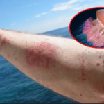 Cách sơ cứu khi bị sứa biển tấn công